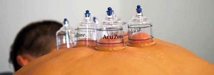 A patient with cupping cups applied to their back