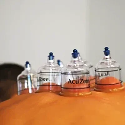 Acu Zone glass cupping cups on a patient's back