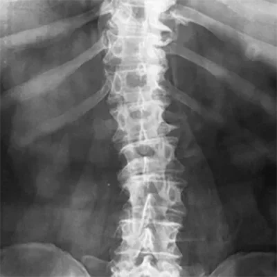 An x-ray showing scoliosis of the spine